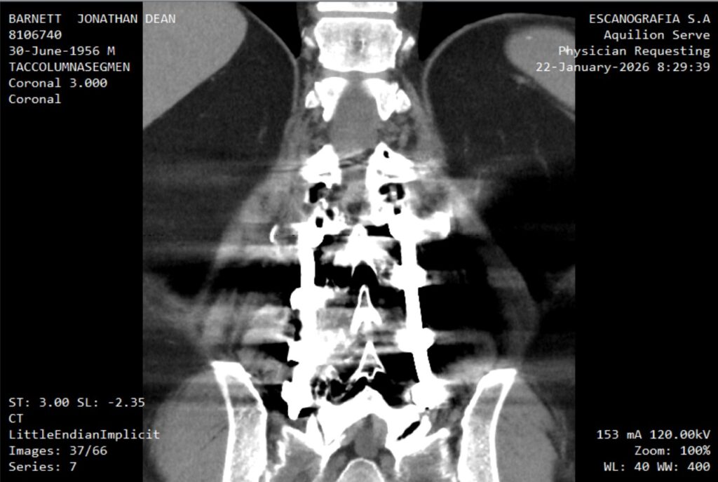 CT scan showing spinal fusion cage