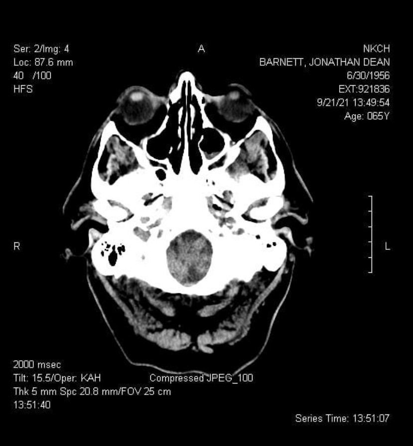 MRI of brain with white matter disease
